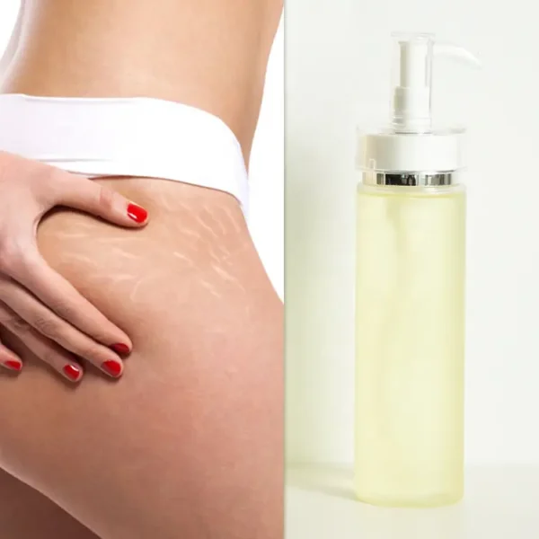 repairing moisturizing stretch mark removal oil treatment for stretch marks anti body stretch marks